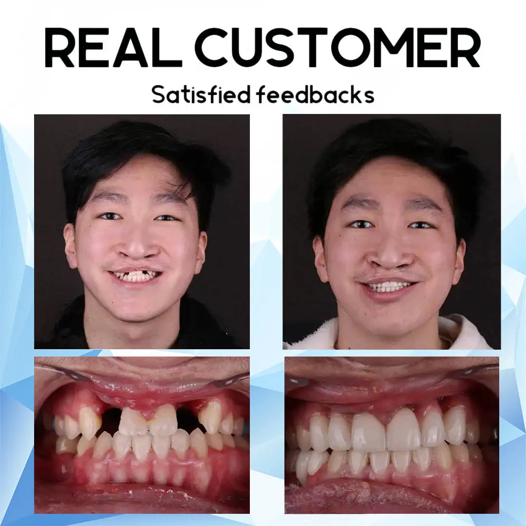 SmilePro™ – High-quality, Individually Fitted Silicone Denture Set