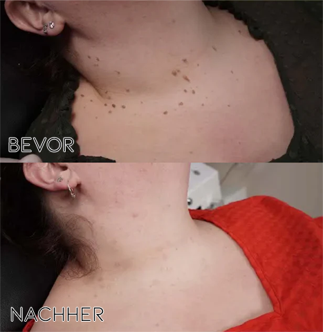 1+1 FREE | BeeNaturale™ Pain-Free Skin Renewal