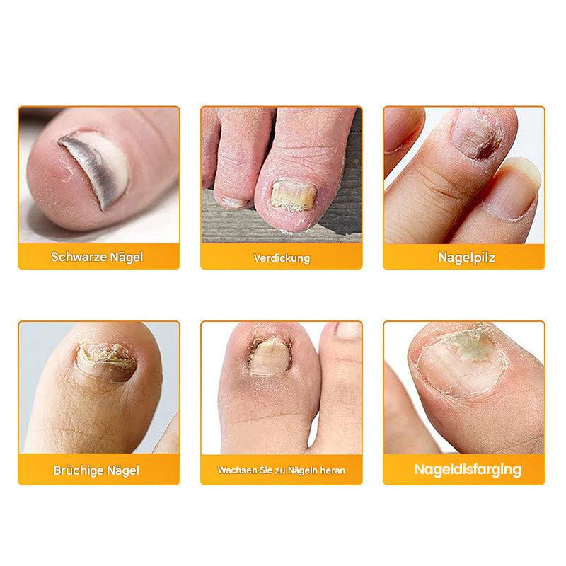 1+1 Free | Nailox™ – Clear, healthy nails with discreet all-day care