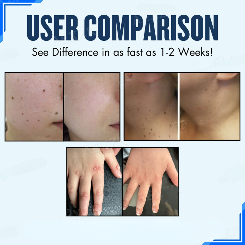 1+1 FREE | ClearSkin™ Effective Removal Of Moles And Warts