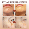 1+1 FREE | WipeOff™ Quickly Removes Skin Tags for Smooth, Confident Skin