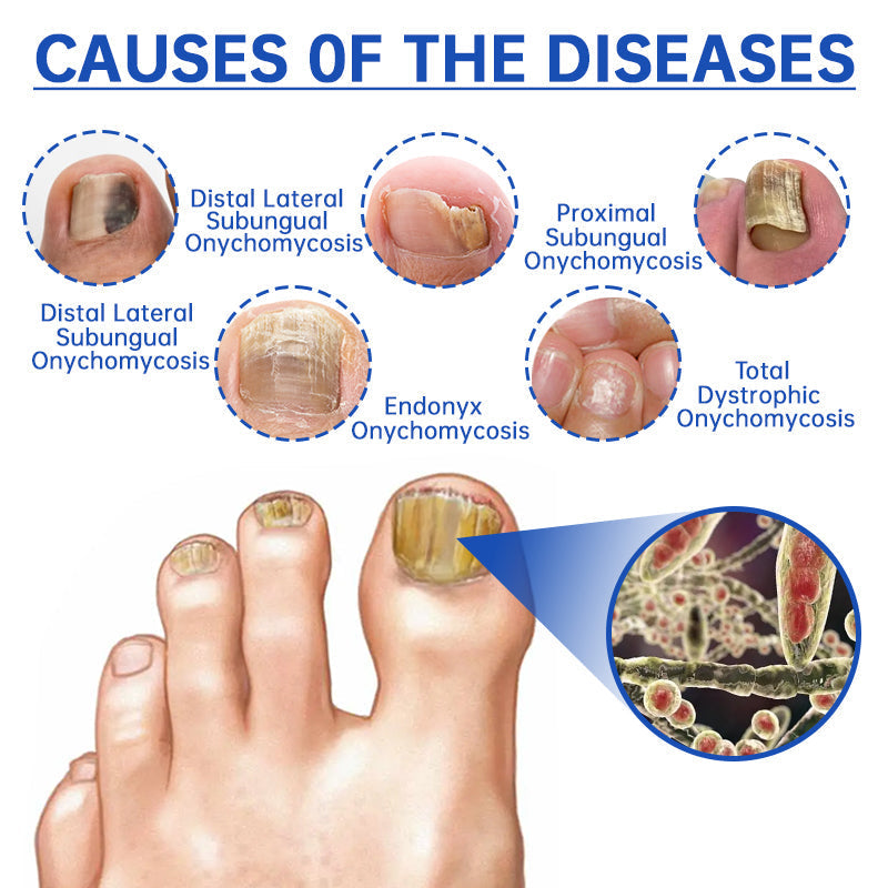 FungusX™ - Fungus Therapy Device