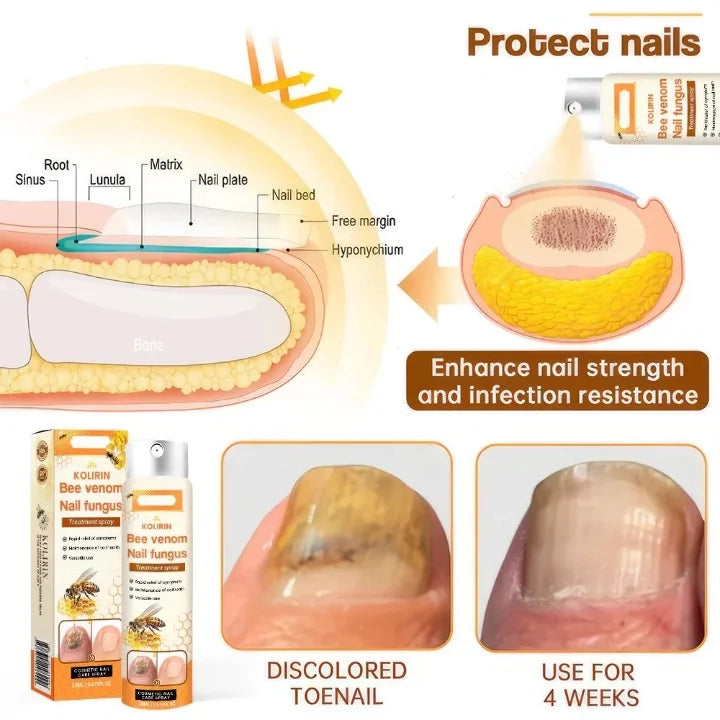 1+1 FREE | Venomix™ Say goodbye to nail fungus in just 2 weeks!