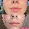 LumiGlow™ - Pain-free Treatment: Non-invasive Therapy