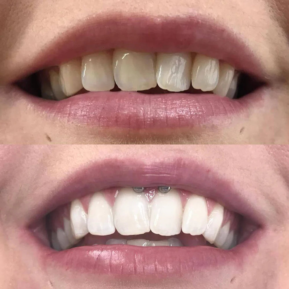 1+1 Free | Diamond Smile™ — Unleash Your Shine and Shine with Confidence