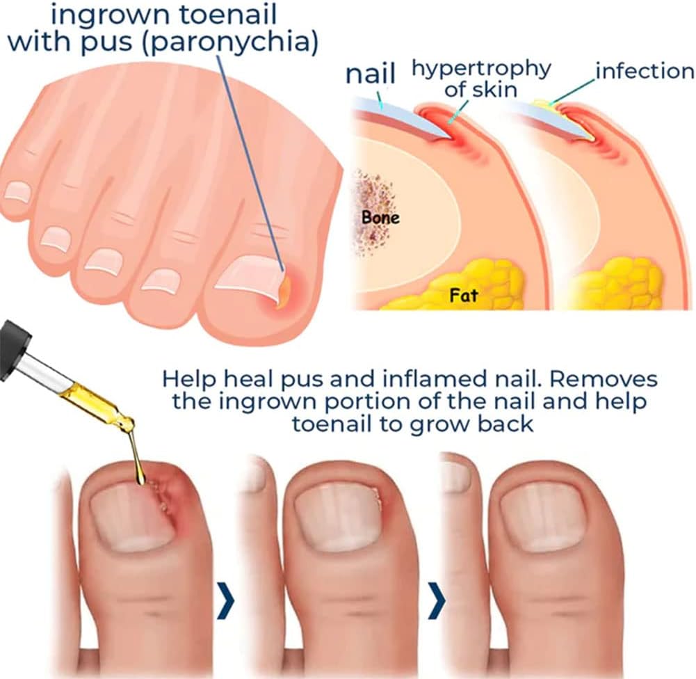 HealDrop™ - Regenerate Damaged Nails in 4 Weeks
