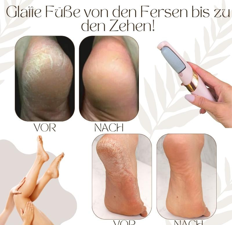 CallusPro™ - Electric Callus Remover