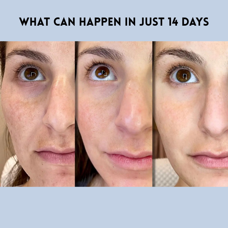 1+1 FREE | YouthLift Renew Strips™ Combat Fine Lines and Sagging Skin in Minutes