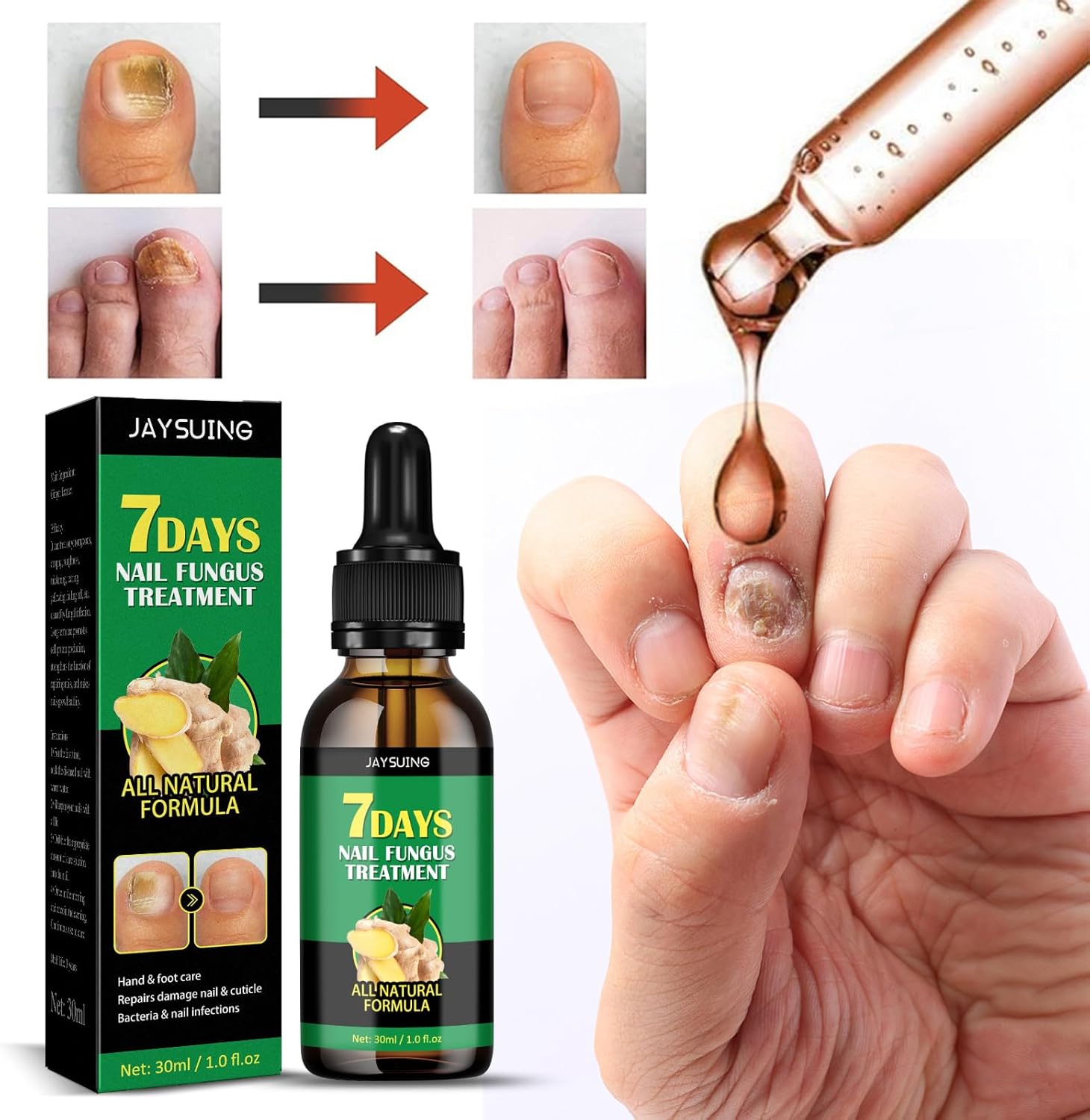 FungiGone™ - For Healthy, Beautiful Nails Without Fungus