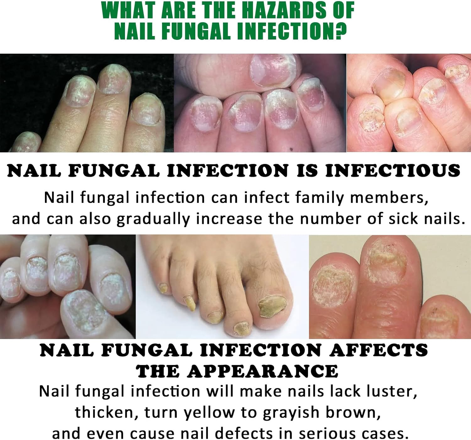 FungiGone™ - For Healthy, Beautiful Nails Without Fungus