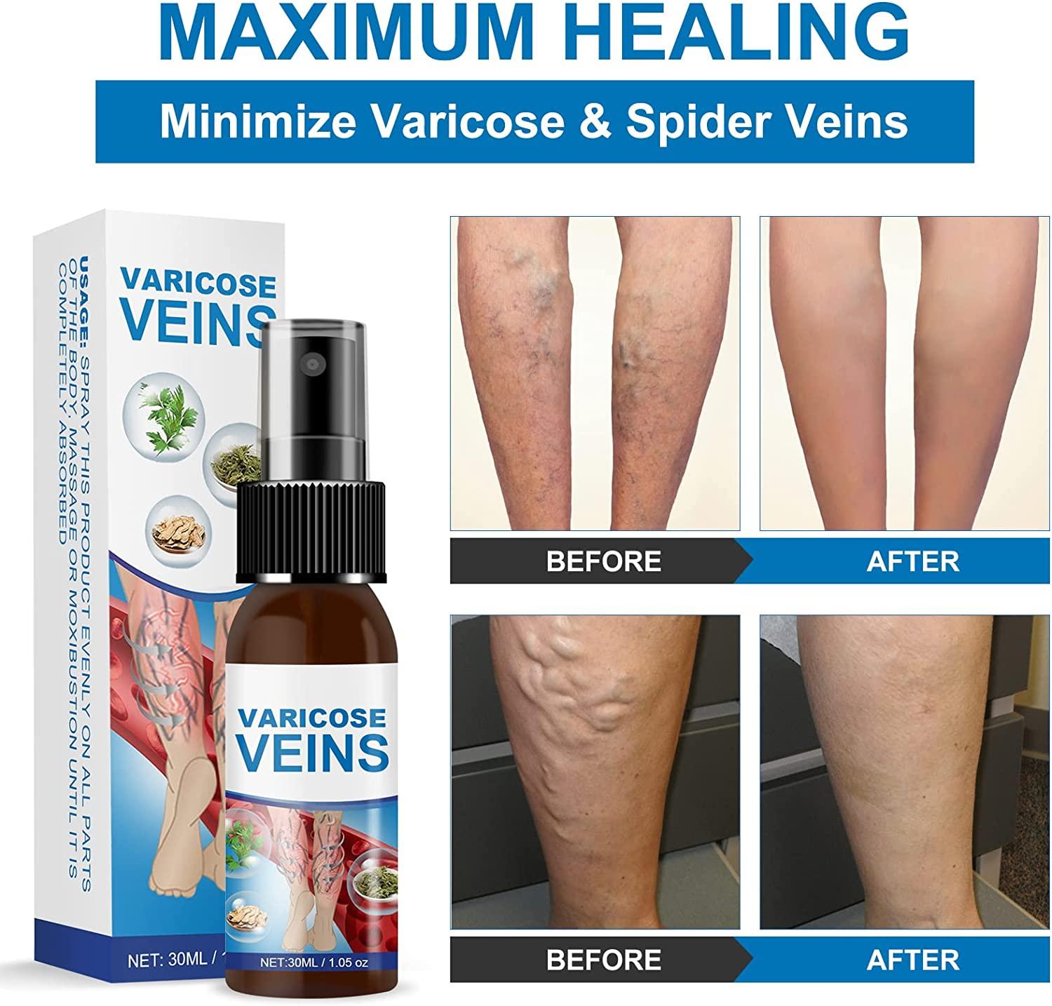 1+1 Free | Varicose Vein Spray™ - Treat varicose veins without surgery!