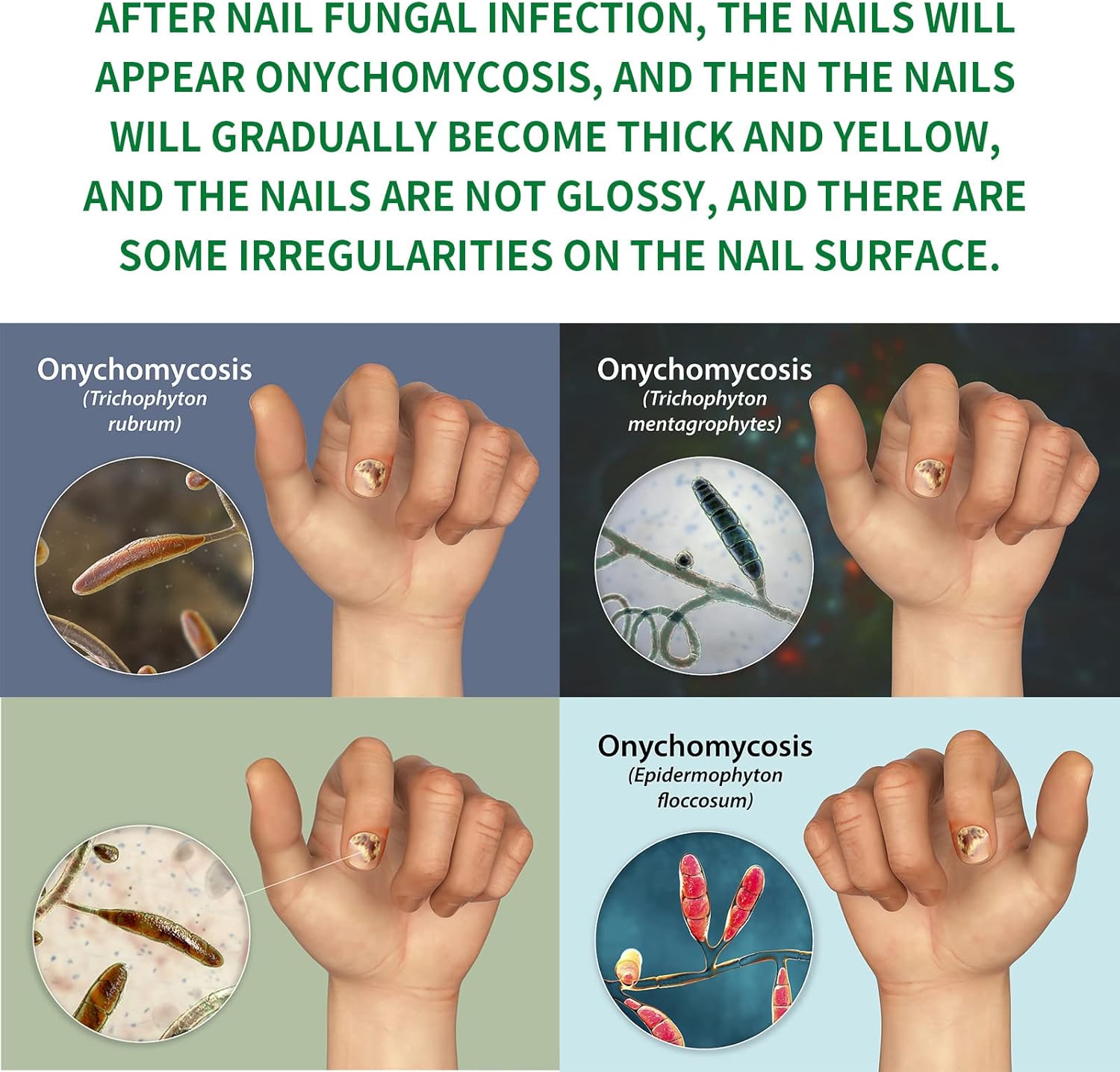 FungiGone™ - For Healthy, Beautiful Nails Without Fungus