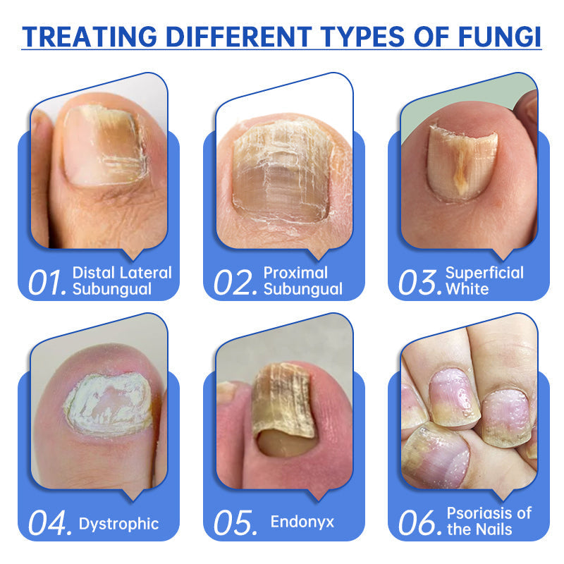 FungusX™ - Fungus Therapy Device