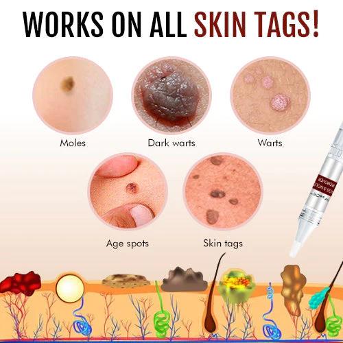 1+1 FREE | WipeOff™ Tags & Mole Remover