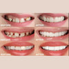 1+1 Free | SnapSmiles™ Snap-on Dentures