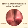 1+1 Free | PureGlow Black Tea Mask™ – Clear, youthful skin that exudes confidence