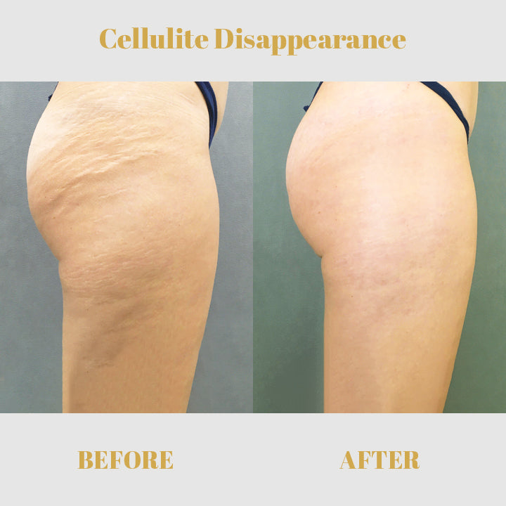 1+1 FREE | PeachyBum™ Reduces the appearance of cellulite