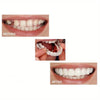 1+1 Free | SnapSmiles™ Snap-on Dentures