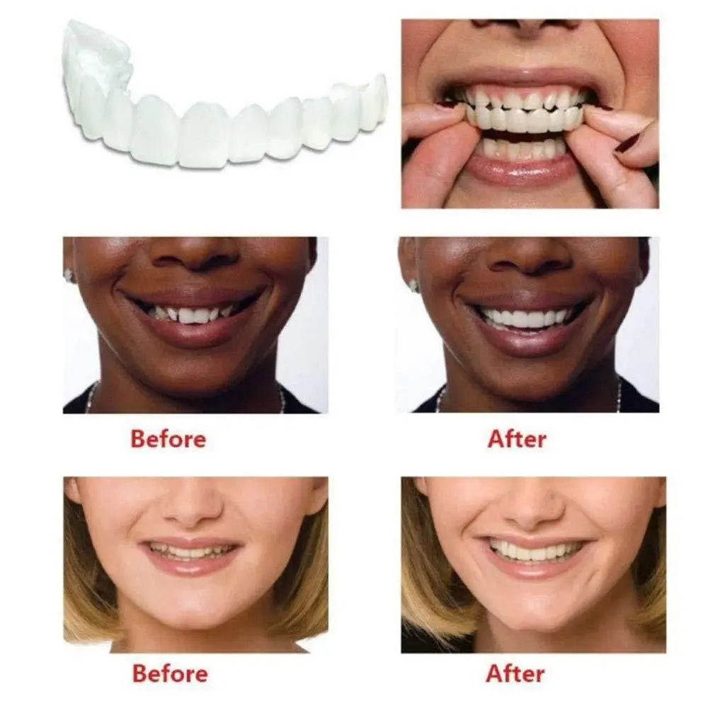 1+1 Free | SnapSmiles™ Snap-on Dentures