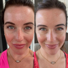 LumiGlow™ - Pain-free Treatment: Non-invasive Therapy