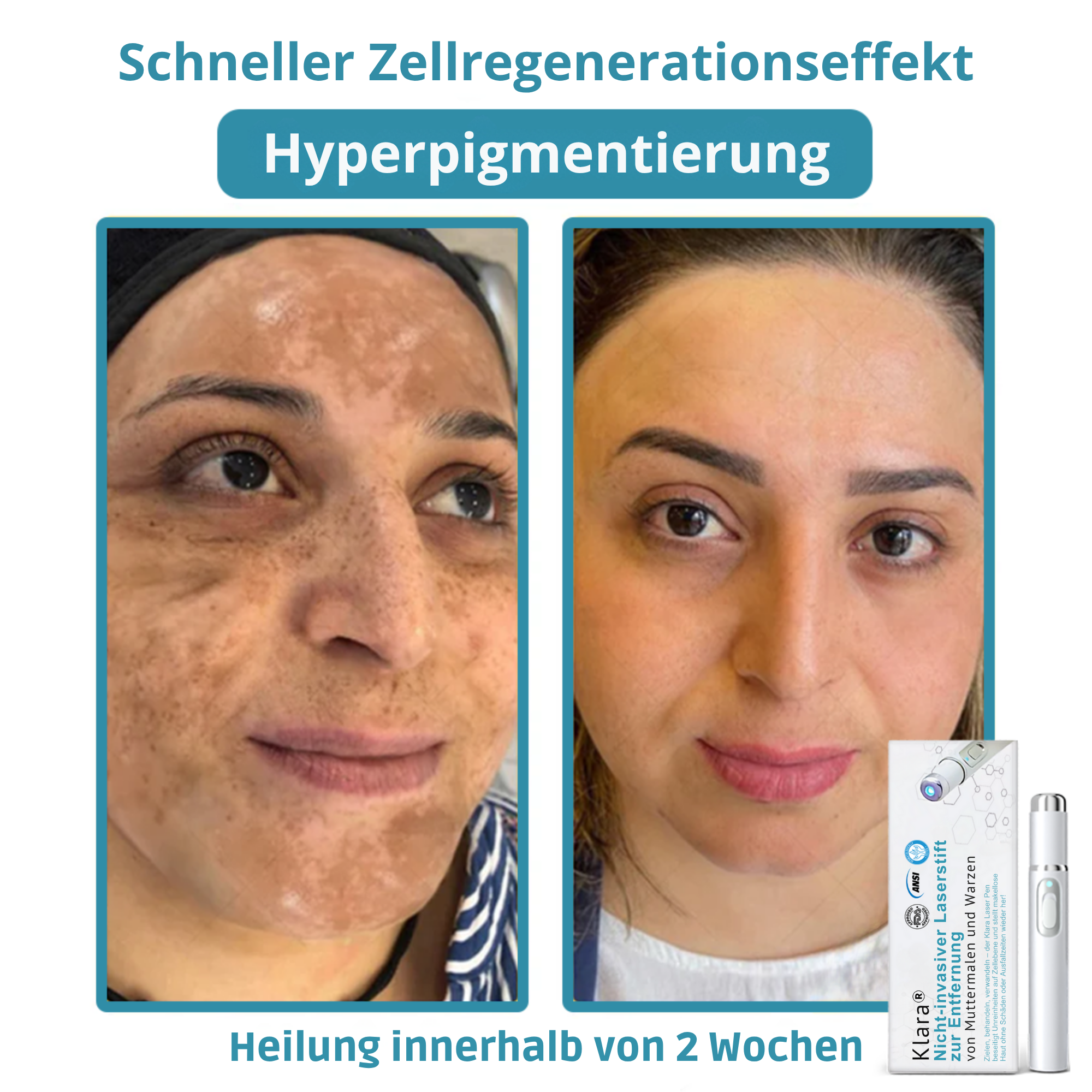 Klara™ Painless Laser Pen — Reveal Flawless Skin And Confidence Anytime