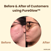 1+1 Free | PureGlow Black Tea Mask™ – Clear, youthful skin that exudes confidence