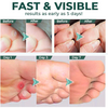 1+1 Free | FootPro™ - Corn Removal Extra Strength Gel
