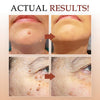 1+1 FREE | WartOff™ Easy Removal Of Skin Spots And Moles