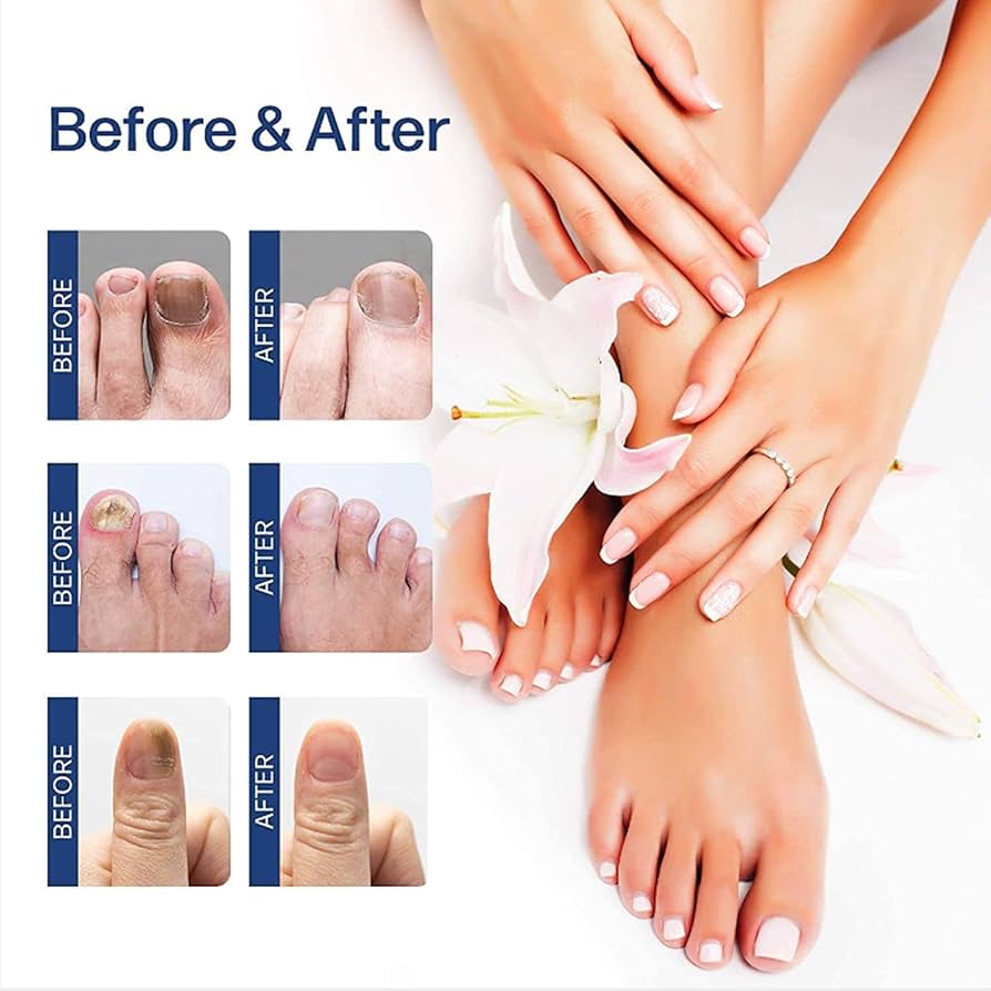 NailRevive™ – Effective Fungal Treatment