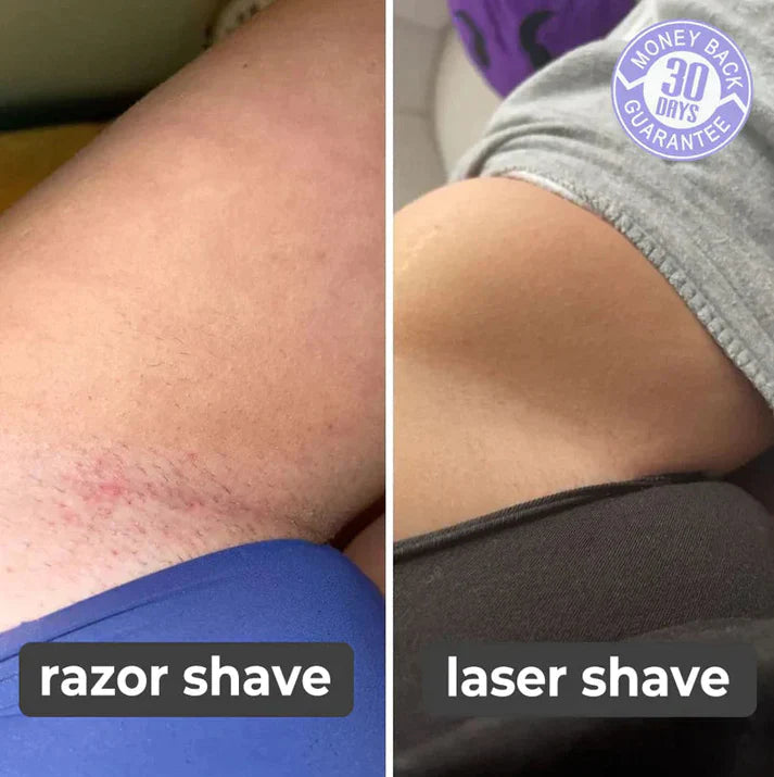 1+1 FREE | LaserRemover™ Painless Hair Removal