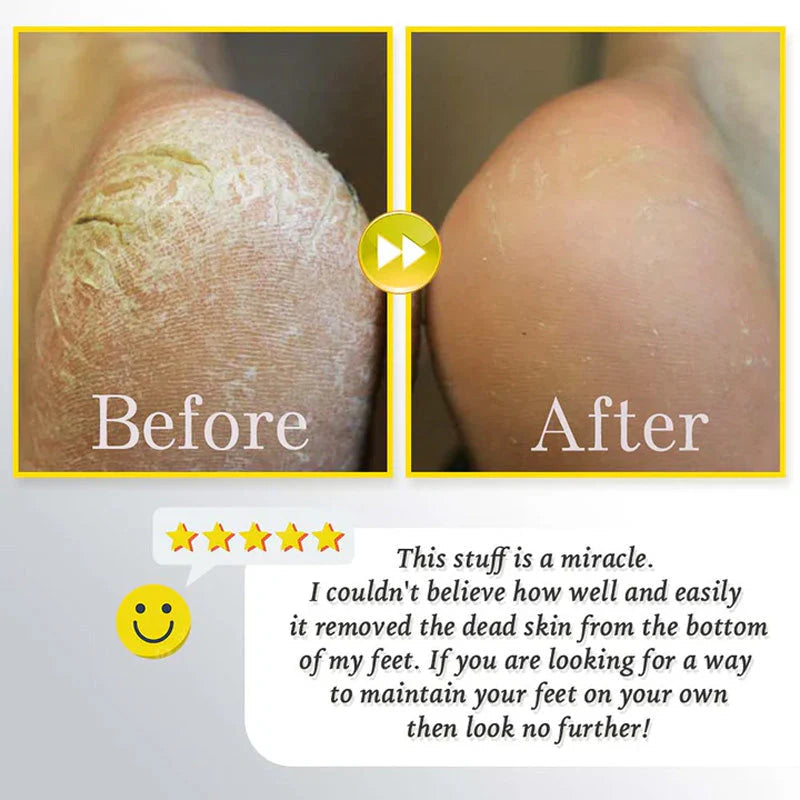 Gleam™ - Gentle Corn Removal for Soft, Smooth Feet