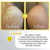 Gleam™ - Gentle Corn Removal for Soft, Smooth Feet