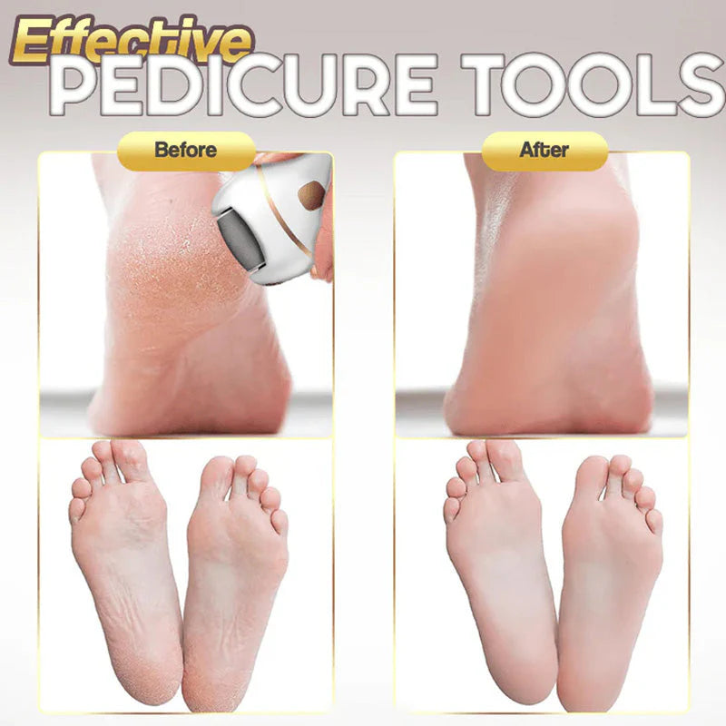 Gleam™ - Gentle Corn Removal for Soft, Smooth Feet